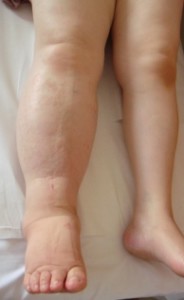 Bir lenf ödem hastası