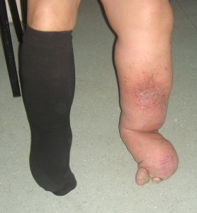 Lenf Ödemli bir hasta